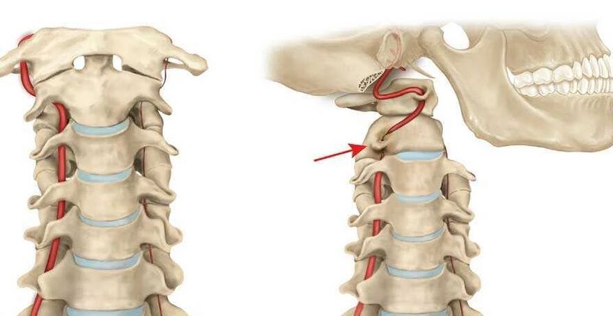 sindrome dell'arteria vertebrale