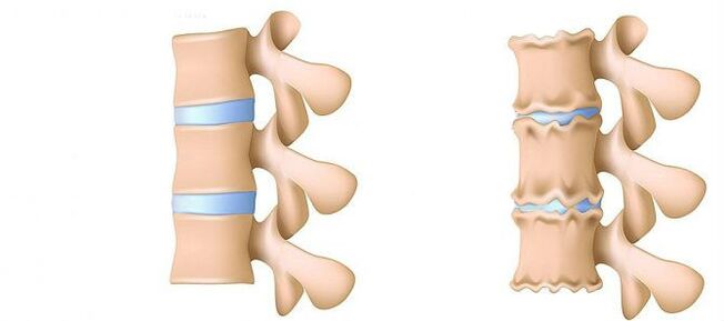Cos'è l'osteocondrosi