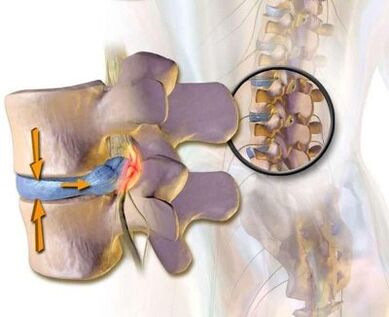 Sindrome da marrone vascolare