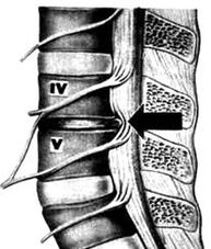 X -RAY Immagine del dipartimento lombare di osteocondosi