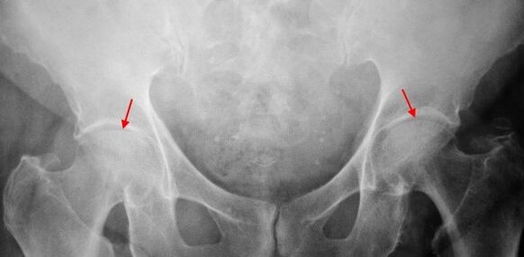 Coksartrosi a doppia facciata che sostengono il divario articolare, sclerosi delle superfici articolari