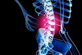 osteocondrosi della colonna lombare