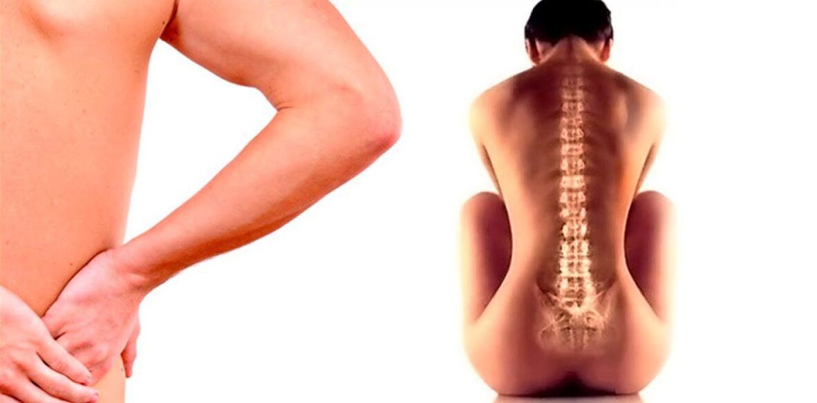 lombalgia dovuta all'osteocondrosi