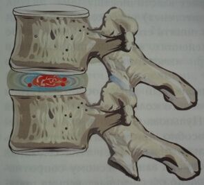 Primo stadio dell'osteocondrosi