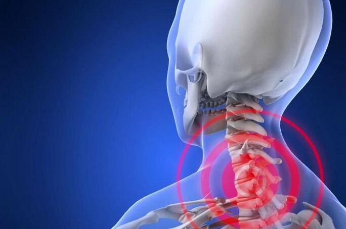 Il dolore lancinante al collo è un sintomo precoce dell'osteocondrosi cervicale