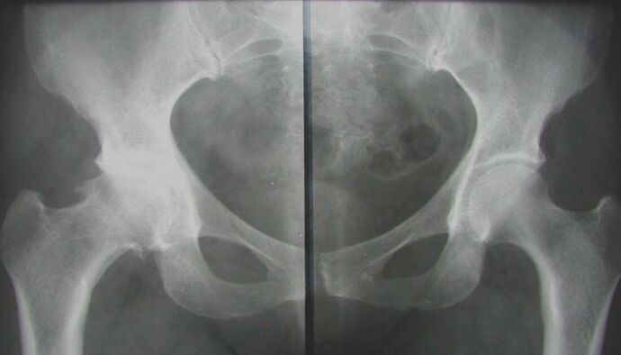 radiografia dell'articolazione dell'anca colpita con artrosi